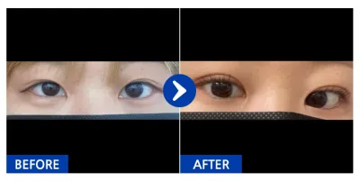 [Babitalk] 自然黏連 (雙眼皮) / 第1個月 / 暱稱：堂山美女