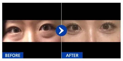 [江南姐姐] 眼底脂肪重置 / 1個月 / 暱稱：Sseuing