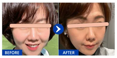 [江南姐姐] 眼底脂肪重新配置 第1個月 / 暱稱：櫻桃豆7