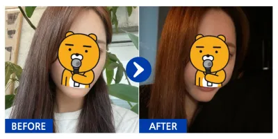 [江南姐姐] 顴骨術後1個月 / 暱稱：유후후후후ㅜ