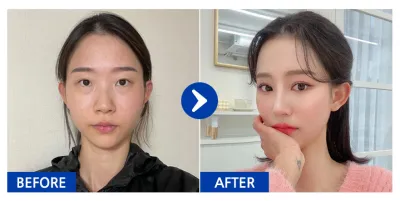 [Babitalk] 眼部修復手術、眼底脂肪重置、鼻部、輪廓2項（顴骨、下頜角）、胸部（魔滴）、脂肪移植（額頭、蘋果肌） / 第3個月 / 暱稱：듀듀듀쥬쥬