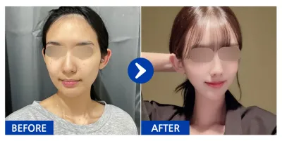 [江南姐姐] 輪廓2項（下頜角、顴骨）第1個月 / 暱稱：투율이