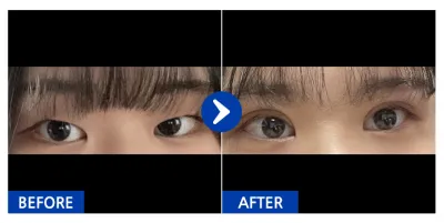 [江南姐姐] 雙眼皮（切開法）、提眼肌手術 第1個月 / 暱稱：용쩌구