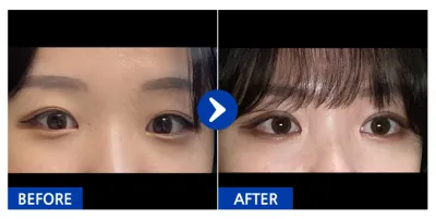 [江南姐姐] 雙眼皮 1個月 / 暱稱：쁘띠웅덩