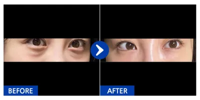 [江南姐姐] 眼底脂肪重置 第7天 / 暱稱：동지금지