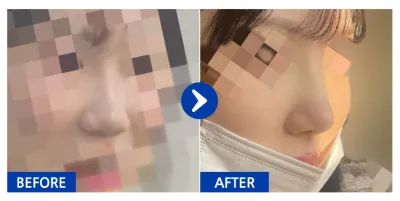 [江南姐姐] 隆鼻手術滿一個月 / 暱稱：luckyyeji