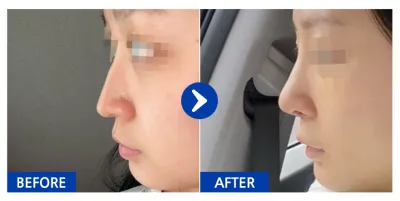 [江南姐姐] 隆鼻第1週 / 暱稱：쀵삥