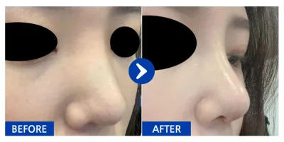 [Babitalk] 隆鼻術後1個月 / 暱稱：融伊娜