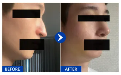 [Babitalk] 隆鼻第1個月 / 暱稱：여우9Kcqw