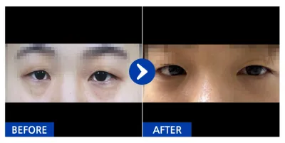 [江南姐姐] 眼底脂肪重新配置 / 1個月 / 暱稱：yykkyyk