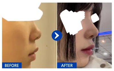 [Babitalk] 隆鼻手術第1個月 / 暱稱：Koko-mon