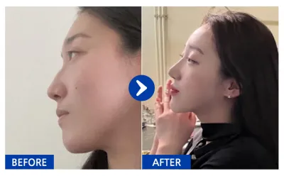 [Babitalk] 隆鼻1年 / 暱稱：atmospe