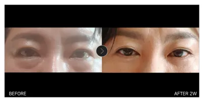 [江南姐姐心得] 下眼瞼 + 埋線拉提 第2週 / 暱稱：嘎尼西尼