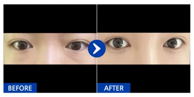 [江南姐姐] 眼底脂肪重新配置 / 1個月 / 暱稱：하잇어