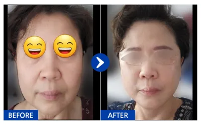 [江南姐姐] 埋線拉提 第1個月 / 暱稱：流氓兔