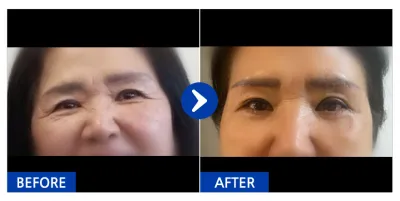 [江南姐姐] 提眉術、下眼瞼 / 1個月 / 暱稱：蠶室Jane