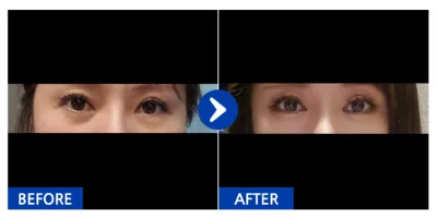 [江南姐姐] 眼底脂肪移植 / 第3週 / 暱稱：順其自然~