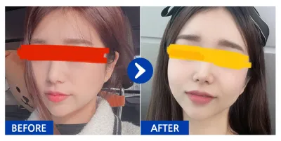 [Babitalk] 全臉脂肪移植 / 1個月 / 暱稱：주유비