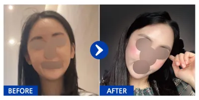 [江南姐姐] 全臉脂肪移植 / 滿1個月 / 暱稱：要變漂亮呀