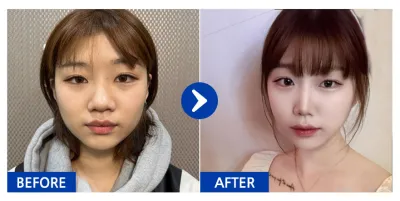 [江南姐姐評價] 隆鼻 / 術後3個月 / 暱稱：웅낭난