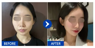 [江南姐姐 評價] 輪廓三項(顴骨、下巴、下顎角)、隆乳(曼陀光滑面) / 術後3個月 / 暱稱：크루루루삥뽕