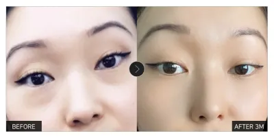 [江南姐姐心得] 眼下脂肪重新配置 第3個月 / 暱稱：大眼蛙