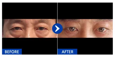 [江南姐姐] 下眼瞼、提眉術 / 1個月 / 暱稱：비제이띠