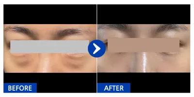 [江南姐姐] 眼底脂肪重置 / 滿1個月 / 暱稱：Ppu-eng-e-u