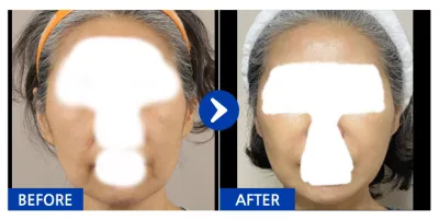 [江南姐姐] 拉皮手術 / 1個月 / 暱稱：安寧姐姐