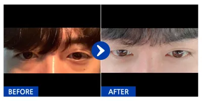 [江南姐姐] 眼底脂肪重新配置 / 第1個月 / 暱稱：金東雲