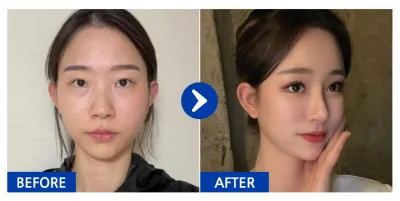 [Babitalk 心得] 眼部修復、鼻部、胸部(Motiva魔滴)、脂肪移植(額頭、前顴骨)、輪廓2項 / 術後6個月 / 暱稱：듀듀듀쥬쥬