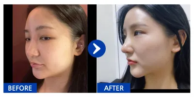 [Babitalk] 隆鼻 / 第2週 / 暱稱：이뽀이쀼2