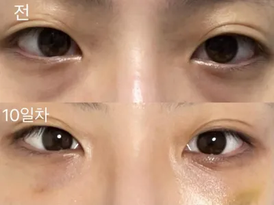 [江南姐姐] 眼底脂肪重新配置 / 第10天 / 暱稱：suntree