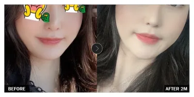 [江南姐姐 後記] 輪廓整形 術後兩個月 / 暱稱：yrBang