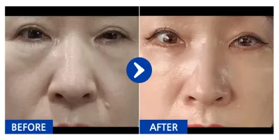 [江南姐姐] 下眼瞼+脂肪移植 / 1個月 / 暱稱：山水香