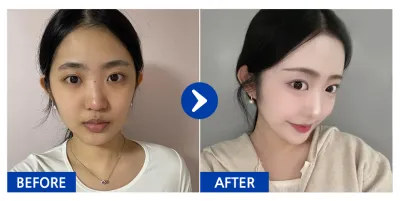 [江南姐姐] 鼻整形 / 第3個月 / 暱稱：喵喵喵嗚嗚