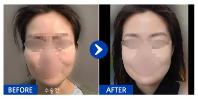 [Babitalk] 臉部輪廓2項（顴骨、下顎角）/ 術後1個月 / 暱稱：토끼65Nsj