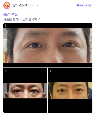 [Babitalk] 眼底脂肪重新配置 / 第2個月 / 暱稱：냥이v26HP