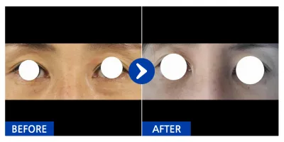 [江南姐姐] 眼底脂肪重新排列 / 第1個月 / 暱稱：車斗里的大腿