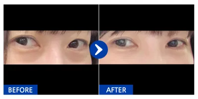 [江南姐姐] 眼底脂肪重新配置 / 第1個月 / 暱稱：Moontan