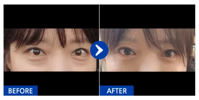 [江南姐姐] 眼底脂肪重置 / 1個月 / 暱稱：아이스피아