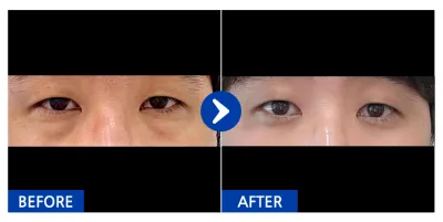 [江南姐姐] 眼底脂肪重新配置 / 1個月 / 暱稱：Pengberry