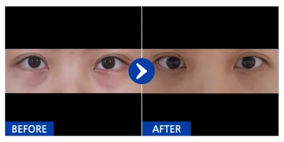 [江南姐姐] 眼底脂肪重新配置 / 1個月 / 暱稱：얍씨