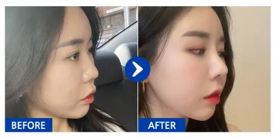 [江南姐姐] 隆鼻 / 1個月 / 暱稱：드르르륵드르륵