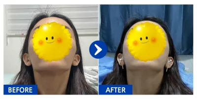 [Babitalk] 顴骨縮小 / 1個月 / 暱稱：Chi-i-i-i-kin