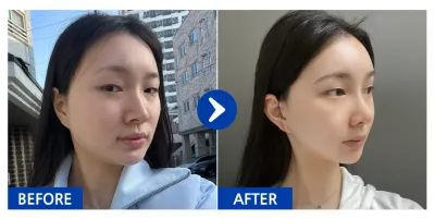 [江南姐姐] 隆鼻、輪廓2項（顴骨、下頜角）/ 術後1個月 / 暱稱：Ko-al-li-eo