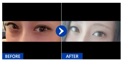 [江南姐姐] 眼底脂肪重置 / 1個月 / 暱稱：棒子姐姐