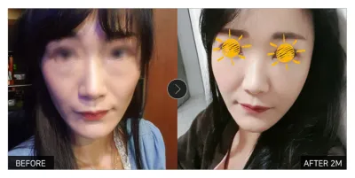 [江南姐姐心得] 全臉脂肪移植+眼底脂肪重置 第2個月 / 暱稱：拉維內