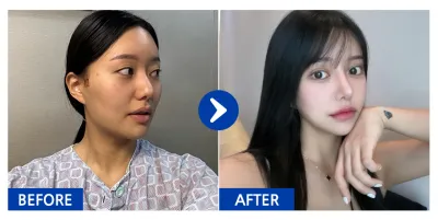 [Babitalk] 輪廓三項、鼻整形 / 術後6個月 / 暱稱：朴丹丹