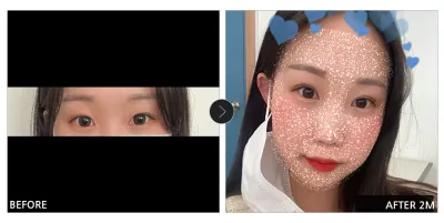 [江南姐姐評價] 眼部整形滿一個月 / 暱稱：花鞋穿戴者